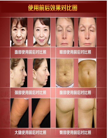热玛吉美容仪 热玛吉美容仪